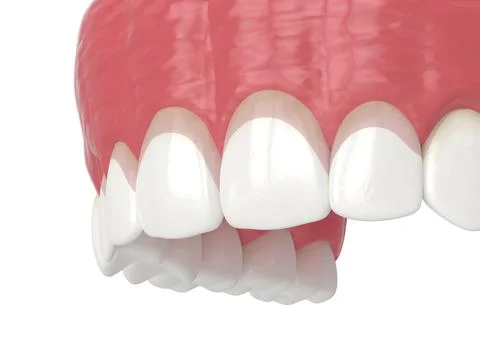 3d render of upper jaw with gummy smile and corrected gum line. Illustrazione stock