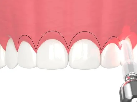 3d render of upper jaw treated with laser for gummy smile. Creating a new g.. Stock Illustration