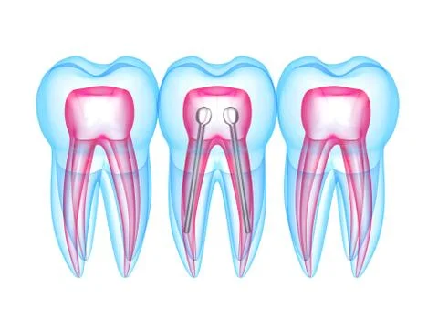 3d render of x-ray teeth with stainless steel dental post Stock Illustration