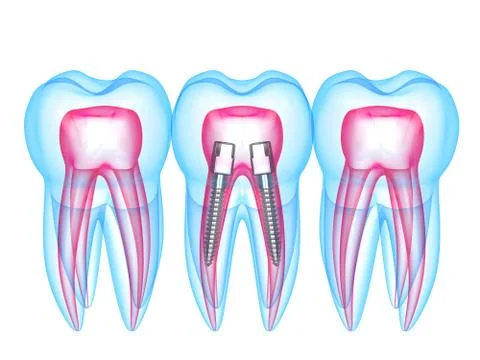 3d render of x-ray teeth with stainless steel dental post Stock Illustration