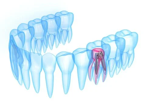 3d render of x-ray teeth with stainless steel dental post Illustrazione stock