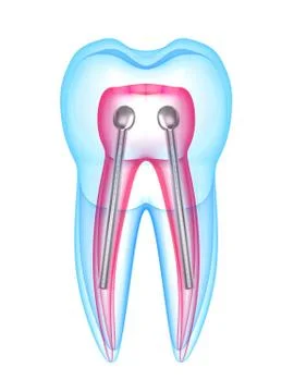 3d render of x-ray tooth with stainless steel dental post Stock Illustration