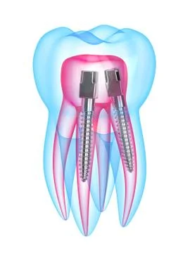 3d render of x-ray tooth with stainless steel dental post Illustrazione stock
