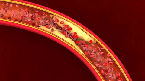 3D rendered Animation of a clogged Artery developing Arteriosclerosis Vídeos de archivo 103683434