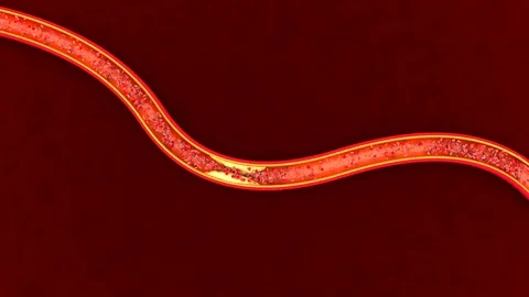 3D rendered Animation of a clogged Artery developing Arteriosclerosis Vídeos de archivo 122688625