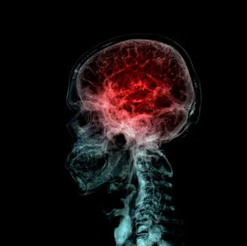 3D rendered medically accurate illustration of the cerebral artery of the hea Stock Illustration