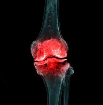 3d renderering of the knee joint  isolated on black background Showing pain a Stock Illustration