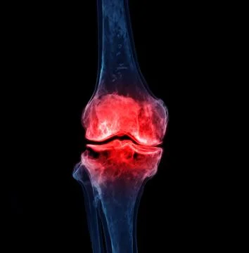 3d renderering of the knee joint  isolated on black background Showing pain a Stock-Illustration
