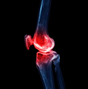 3d renderering of the knee joint  isolated on black background Showing pain a Stock Illustration