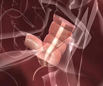 3D rendering of Appendicitis - painful swelling of the appendix, healthcare conc Stock Illustration