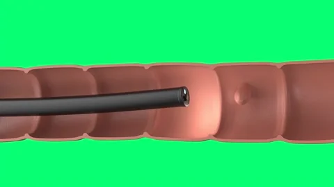 3d rendering endoscope with colonic polyp in intestine isolated on green screen Stock Footage 314692343