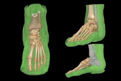 3D rendering  of the foot bones for diagnosis bone fracture and rheumatoid ar Stock-Illustration