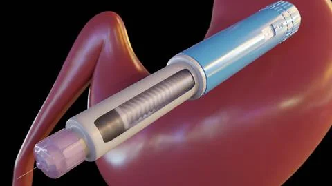 A 3D rendering of GLP-1 or insulin pens positioned over a stomach diagram. Stock Illustration