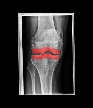 3d rendering of highlighted in red knee joint xray Stock Illustration