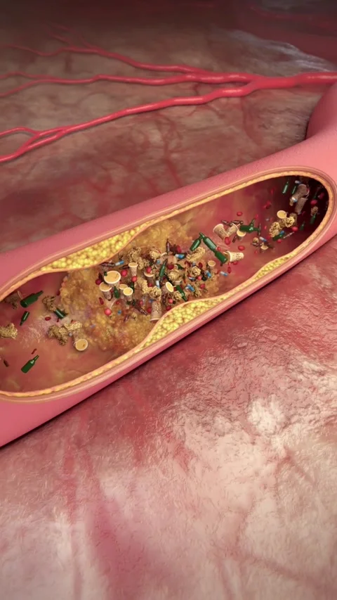 3D rendering: junk food triggers clot formation, plaque buildup, Vídeos de archivo 344953834