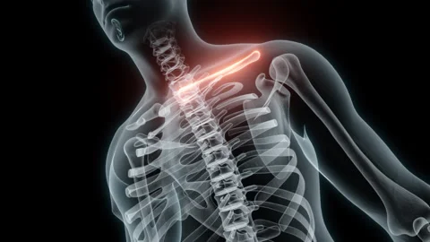 3D Rendering of a Medical Animation of the Collarbone. X-ray of the Collarbone. Stock Footage 239839856