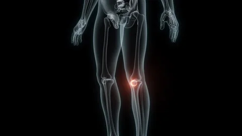 3D Rendering of a Medical Animation of the Knee. X-ray of the Knee. Stock Footage 239852165