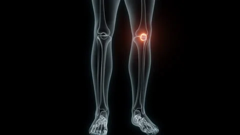 3D Rendering of a Medical Animation of the Knee. X-ray of the Knee. Stock Footage 239853735