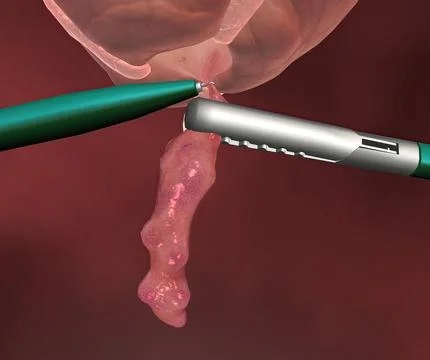 3D rendering of metal tool and closeup of Appendicitis - painful swelling of the Stockillustratie