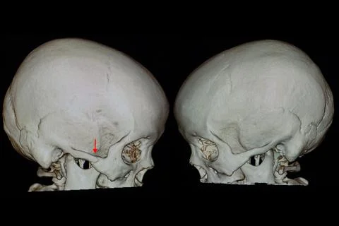 A 3D rendering of a skull with zygomatic bone fracture. Stock Illustration