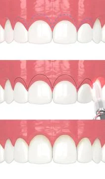 3D rendering of the step-by-step procedure of laser treatment for gummy smile Stock Illustration