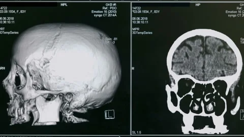 3D scan of a brain, close up. Special equipment scans a patient's brain at a Видео 92016490