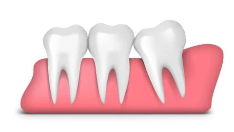 3D Teeth With Wisdom Mesial Impaction Problem Stock Illustration