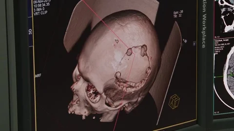 3d tomography of the patient's head Stock Footage 130793731
