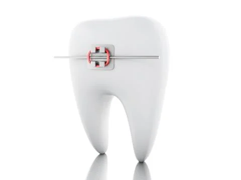 3D Tooth with braces. Stock-Illustration