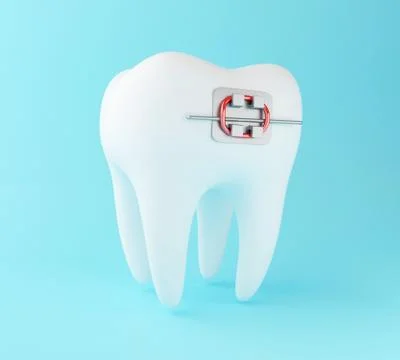 3D Tooth with braces. Stock Illustration