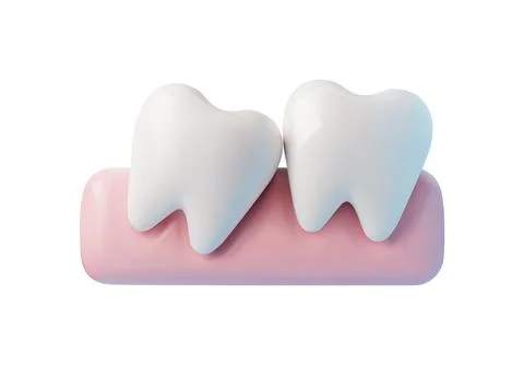 3D tooth grow incorrectly, tilted eruption problems, inflamed gums, vector Stock Illustration