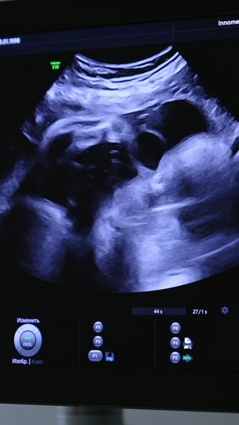 3D ultrasound scan shows developing fetus with detailed facial features in .. Video stock 337634534