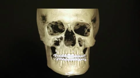 3d x-ray displayed in a computer screen Stock Footage 46530984