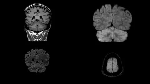 4 Four Comparison of MRI brain sagittal and Axial plane. Stock Footage 236924092