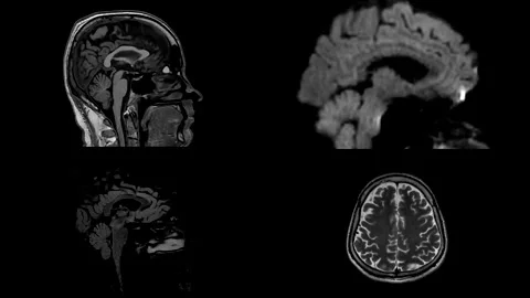4 Four Comparison of MRI brain sagittal and Axial plane. Stock Footage 236924094