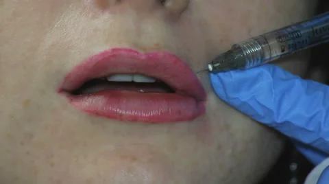 42 Procedure Augmentation Lip Stock Footage 65994490
