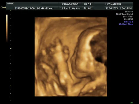4D ultrasound scan of a baby playing in the womb Stock Footage