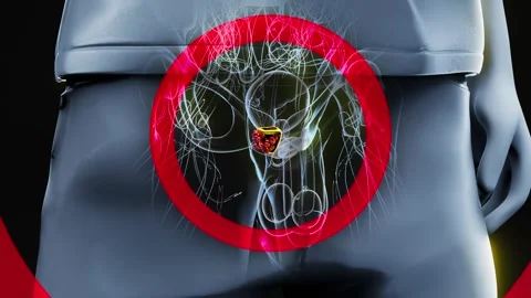 4K abstract 3D animation of the prostate cancer Stock Footage 257530901