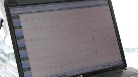 4K. Chart of a fetal electrocardiogram Stock-Footage 78110008