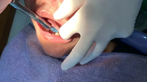 4k Close up of dentist injecting some anesthetics Stock Footage 135969267