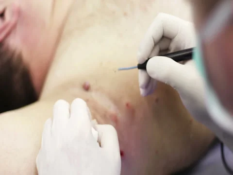 4K Close up Electrocoagulation of papillomas. Stock Footage 73383083