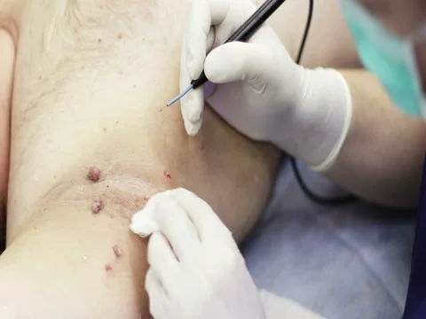 4K Close up. Electrocoagulation of papillomas. Stock Footage 73384815