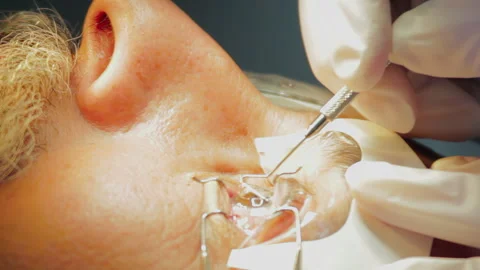 4K Close-Up Eye Surgery-Corneal Flap Creation Before LASIK Procedure Stock Footage 308187199
