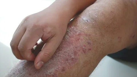 4K Close up shot hands of man scratching skin rash Dermatitis Stock Footage 83120053