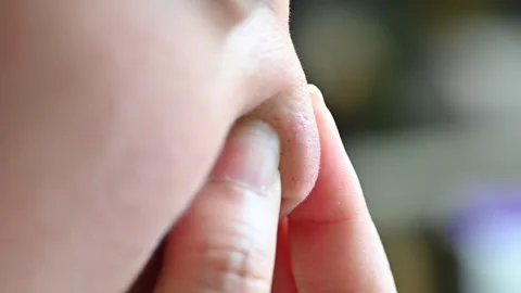 4K Close up of woman squeezing out black heads with her fingers Stock Footage 314587986
