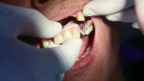 4K Dentist is applying dentures in elderly Stock Footage 330278320