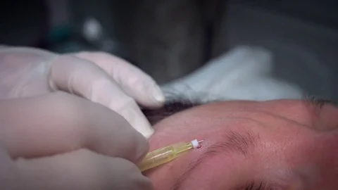 4K Doctor Applying PDO Thread Lifts in Woman Forehead Stock Footage 75842722