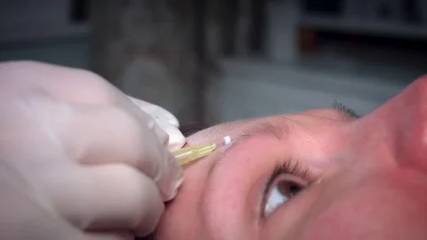 4K Doctor Applying PDO Thread Lifts in Woman Forehead Stock Footage 75843066