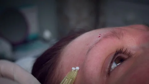 4K Doctor Applying PDO Thread Lifts in Woman Forehead Stock Footage 75843267