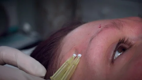 4K Doctor Applying PDO Thread Lifts in Woman Forehead Stock Footage 75843406